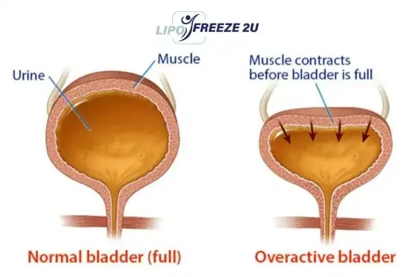 diagram of overactive bladder treatment Reading