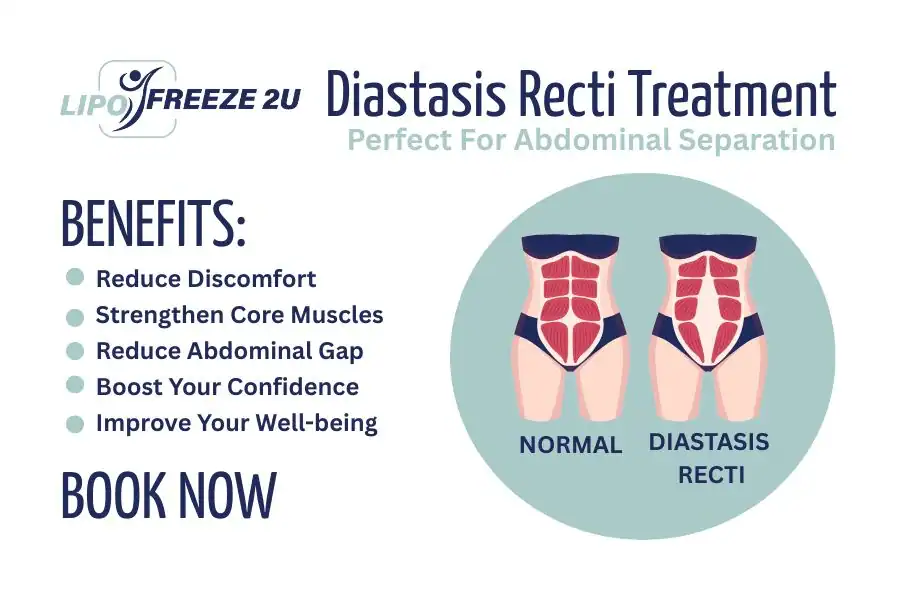 Benefits of body toning treatment Reading for Diastasis recti