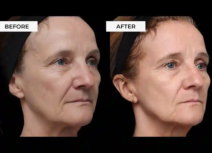 How Many RF Microneedling Sessions Will You Need to See a Difference Reading?