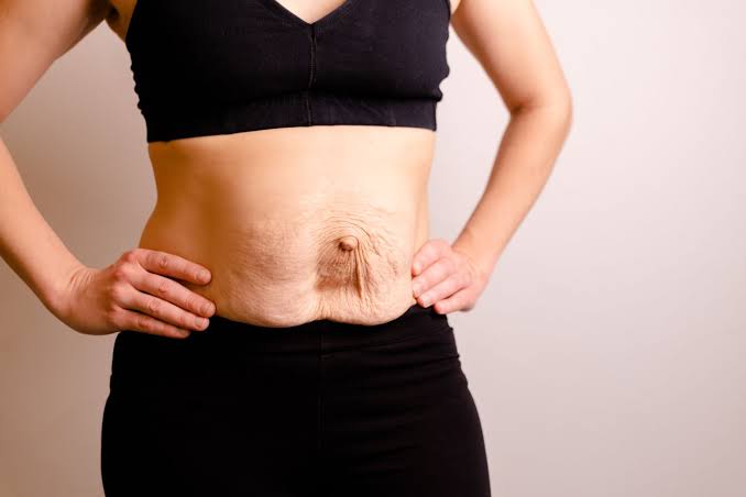 Is Surgery Really the Only Way to Repair Diastasis Recti Reading?