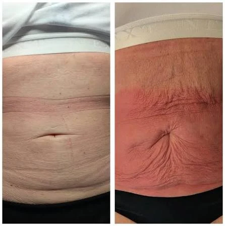 How Does RF Microneedling Improve Crepey, Thin and Uneven Skin Texture Reading?