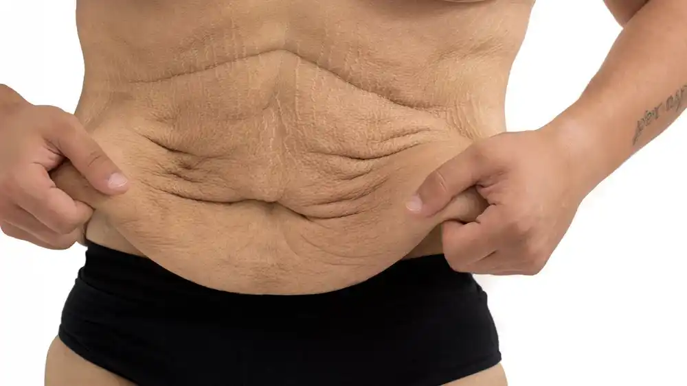 RF Microneedling for Loose Skin: How Can It Help Tighten and Reshape the Skin Reading?